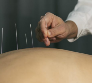 Acupuncture